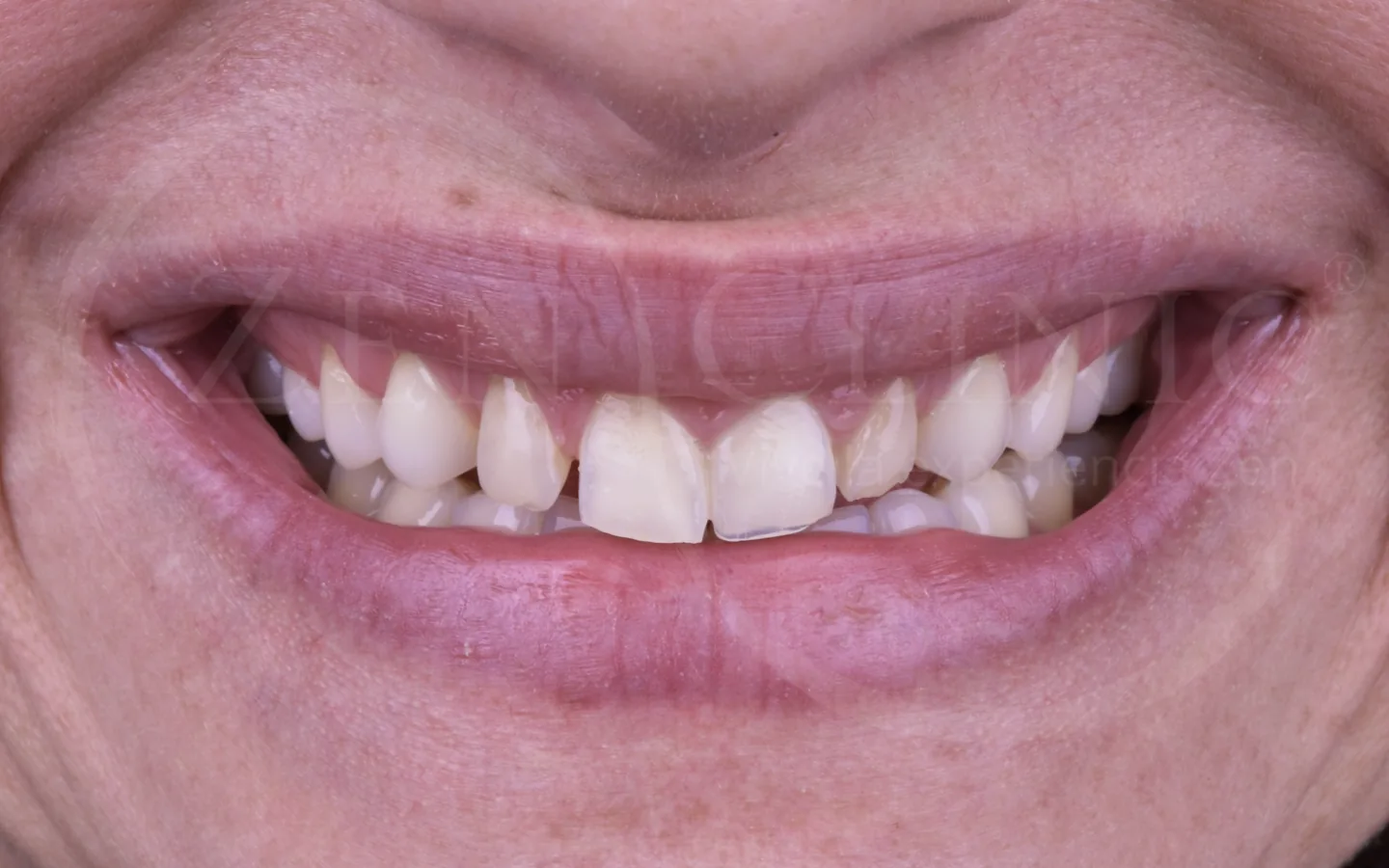 Antes del tratamiento de diseño de sonrisa