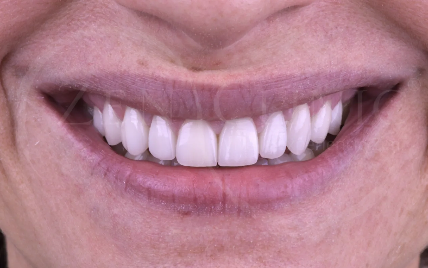 Después del tratamiento de diseño de sonrisa